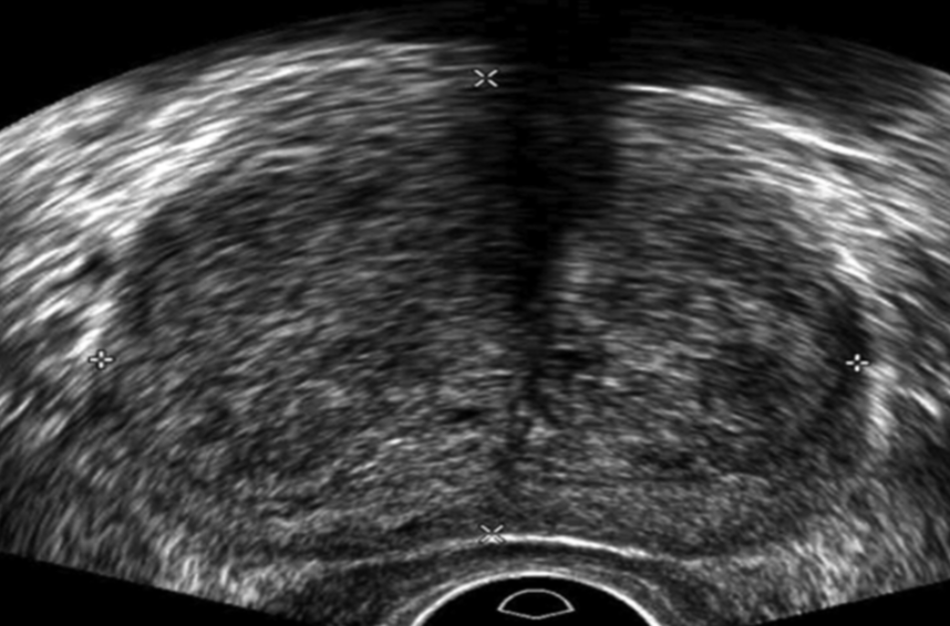 Ultrasound Evaluation of the Prostate
