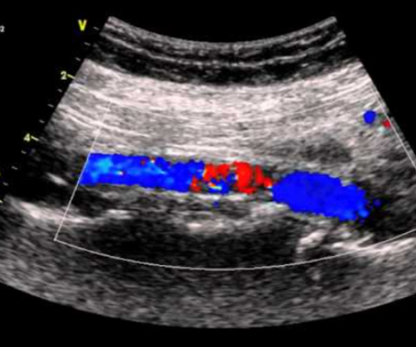 Ultrasound Evaluation of the Abdominal Aorta