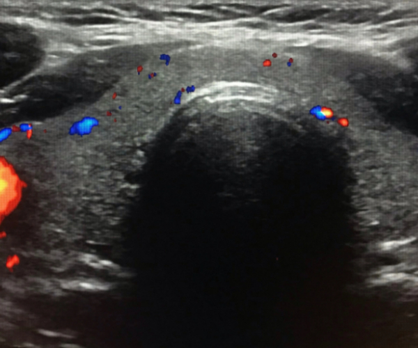 Ultrasound Evaluation of the Thyroid