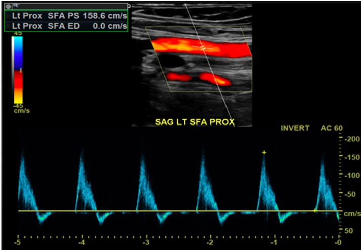 Peripheral Artery Ultrasound