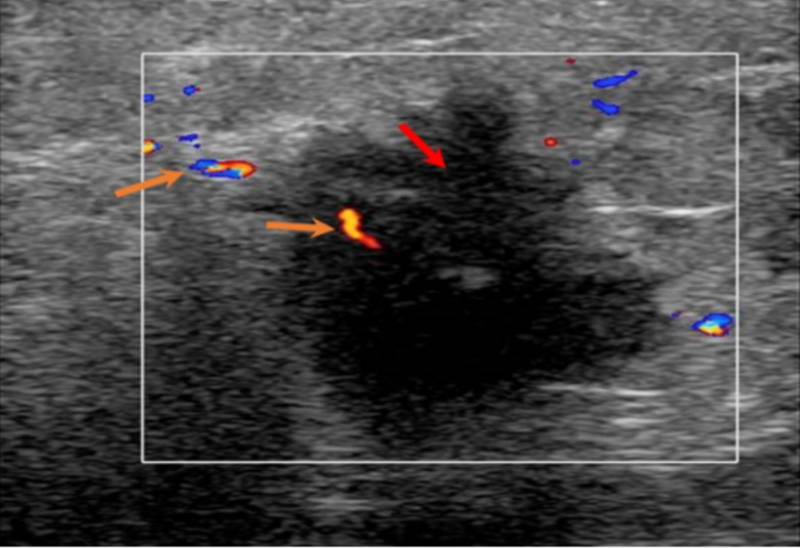 Screening Breast Ultrasound Benefits