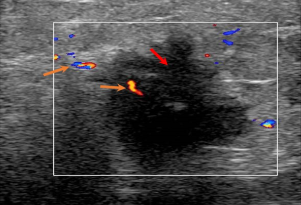 Screening Breast Ultrasound Benefits