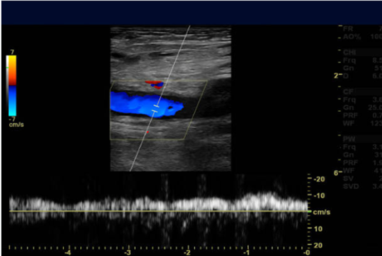 Ultrasound Evaluation of Deep Vein Thrombosis