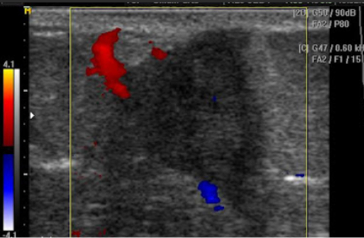 Ultrasound Evaluation of Soft Tissue Masses