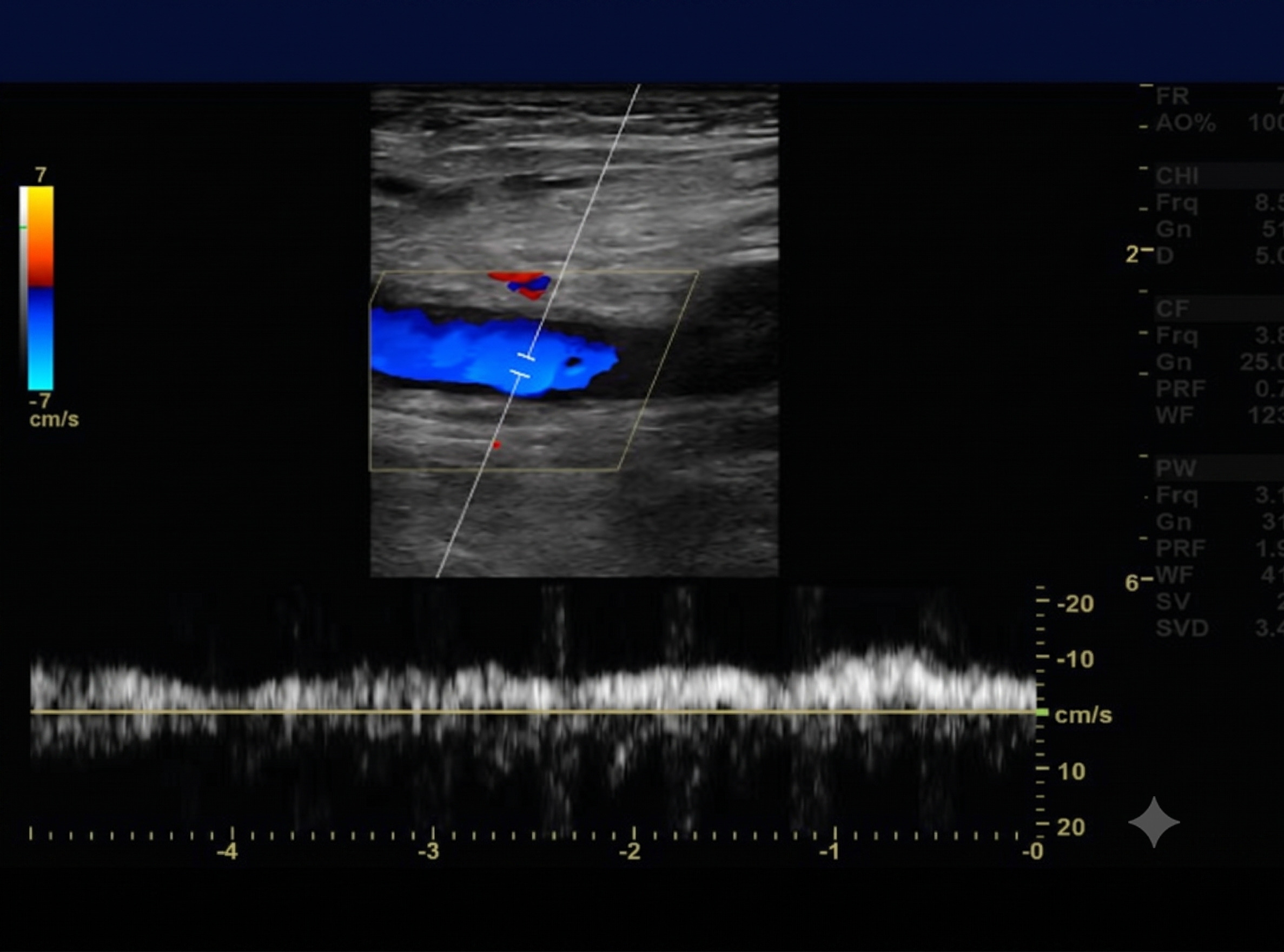Ultrasound Evaluation of Deep Vein Thrombosis