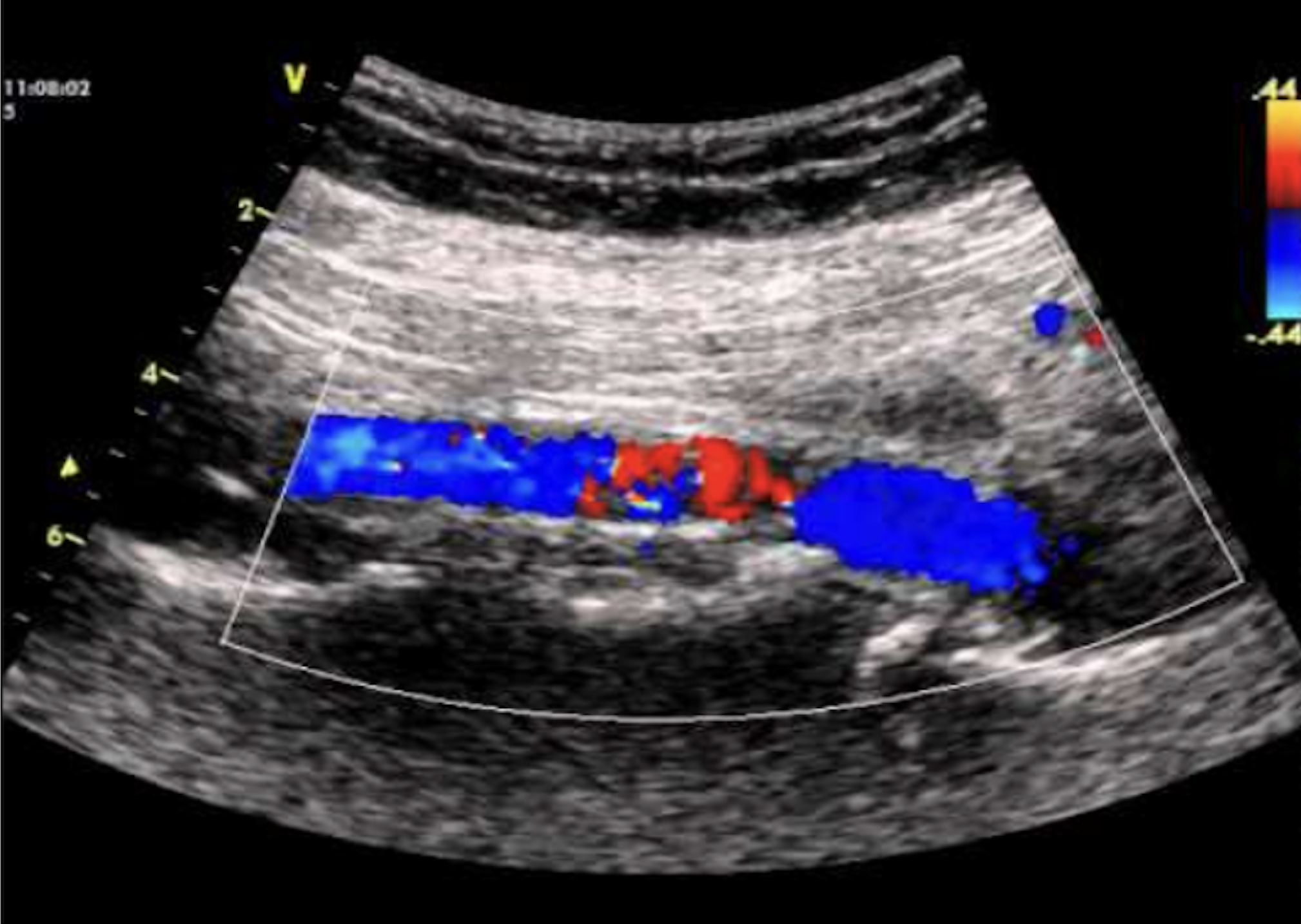 Ultrasound Evaluation of the Abdominal Aorta