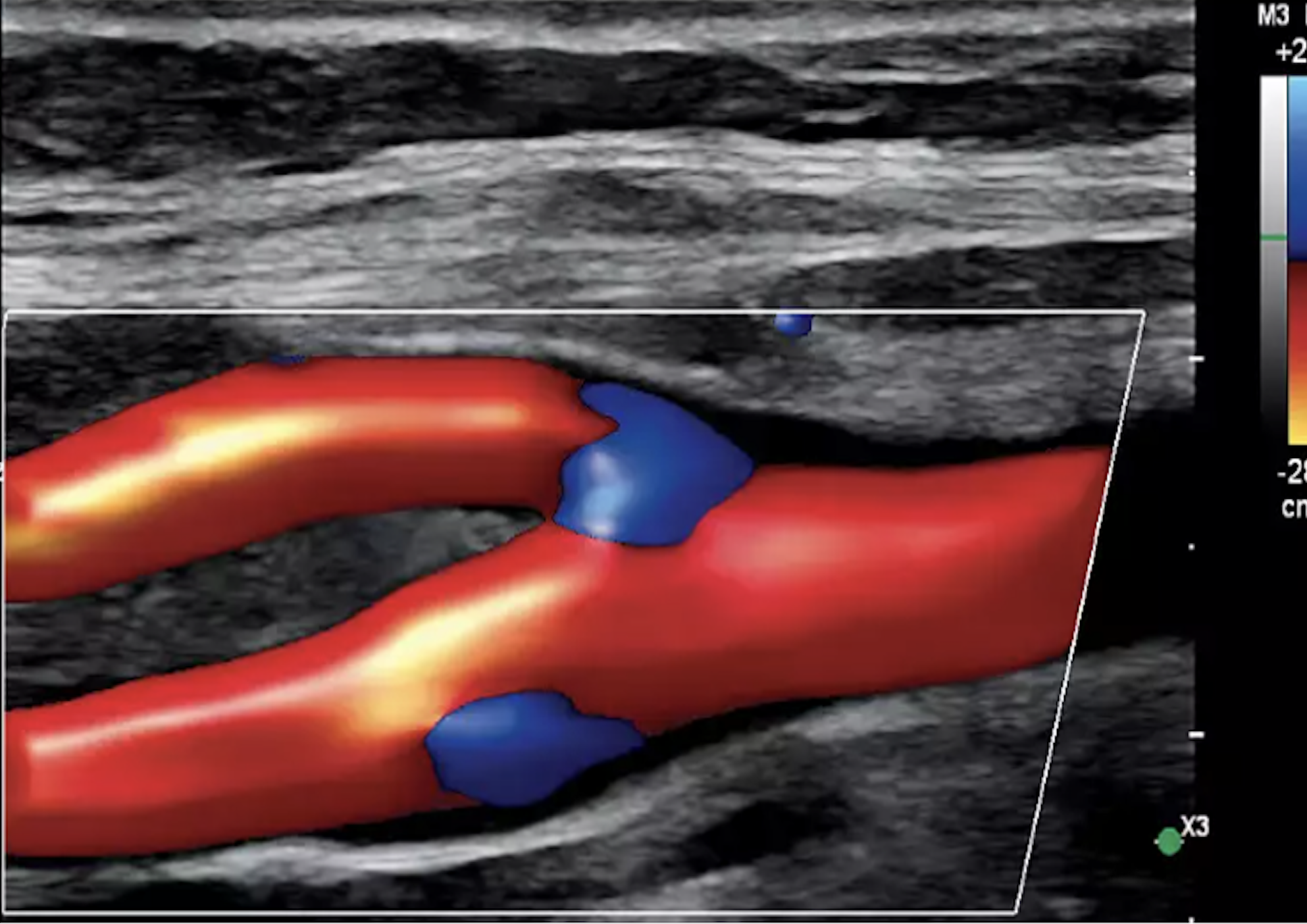Ultrasound Evaluation of the Carotid Artery