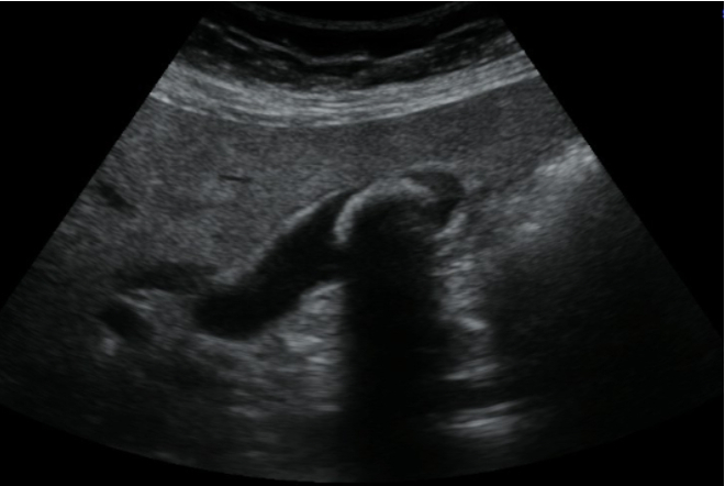 Ultrasound Evaluation of the Gallbladder