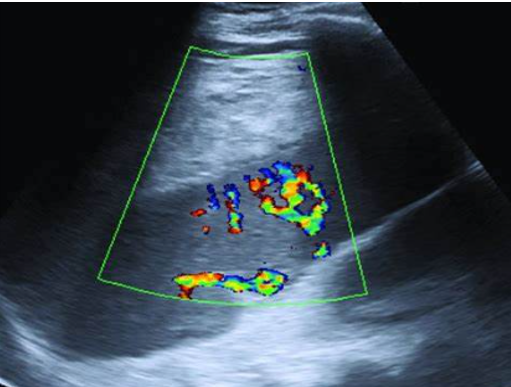 Ultrasound Evaluation of the Gallbladder
