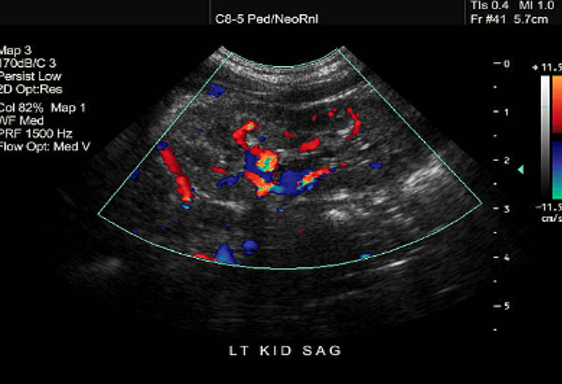 Ultrasound Evaluation of the Kidneys