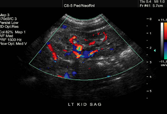 Ultrasound Evaluation of the Kidneys