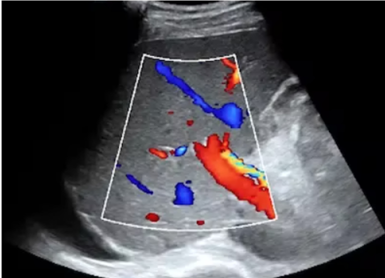 Ultrasound Evaluation of the Liver