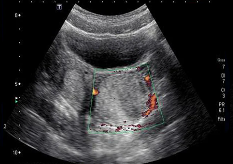 Ultrasound Evaluation of The Ovary