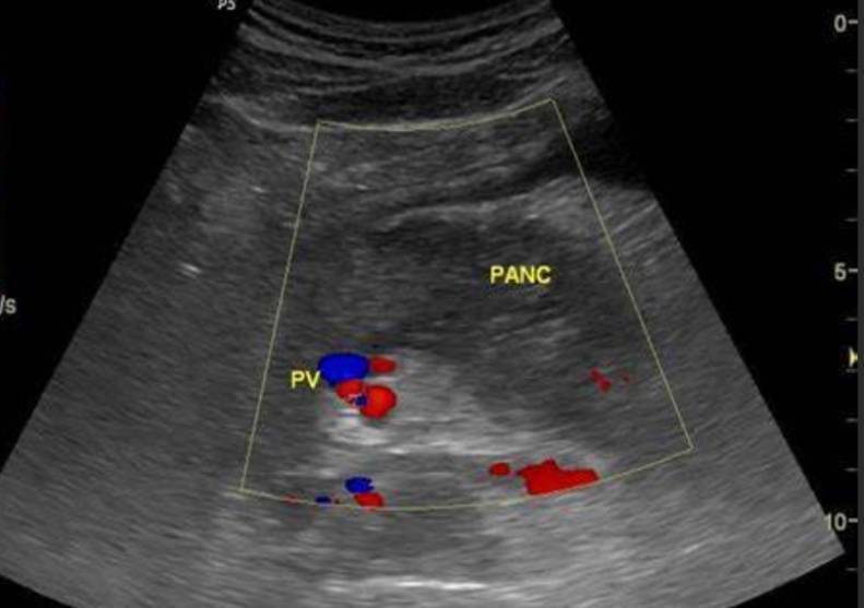 Ultrasound Evaluation of the Pancreas