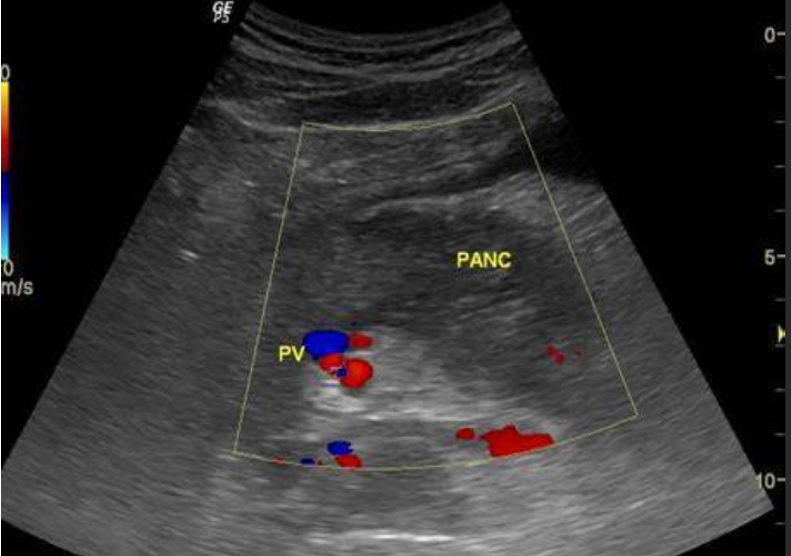 Ultrasound Evaluation of the Pancreas