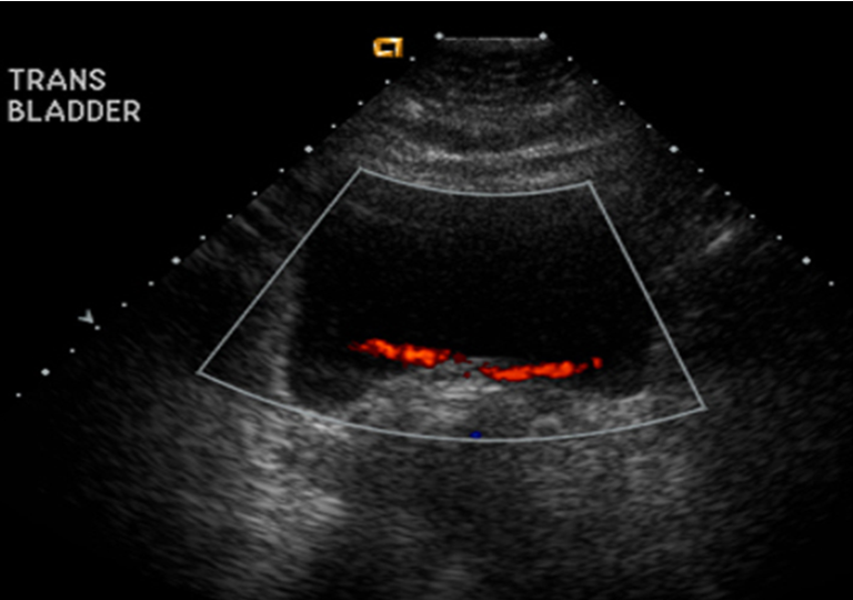 Ultrasound Evaluation of The Urinary Bladder