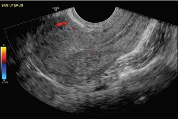 Ultrasound Evaluation of the Uterus