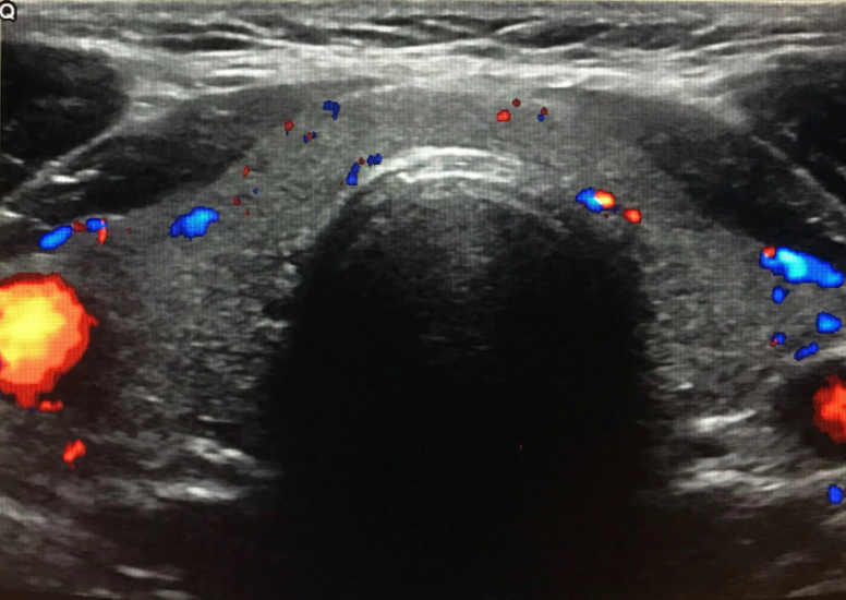 Ultrasound Evalution of the Thyroid